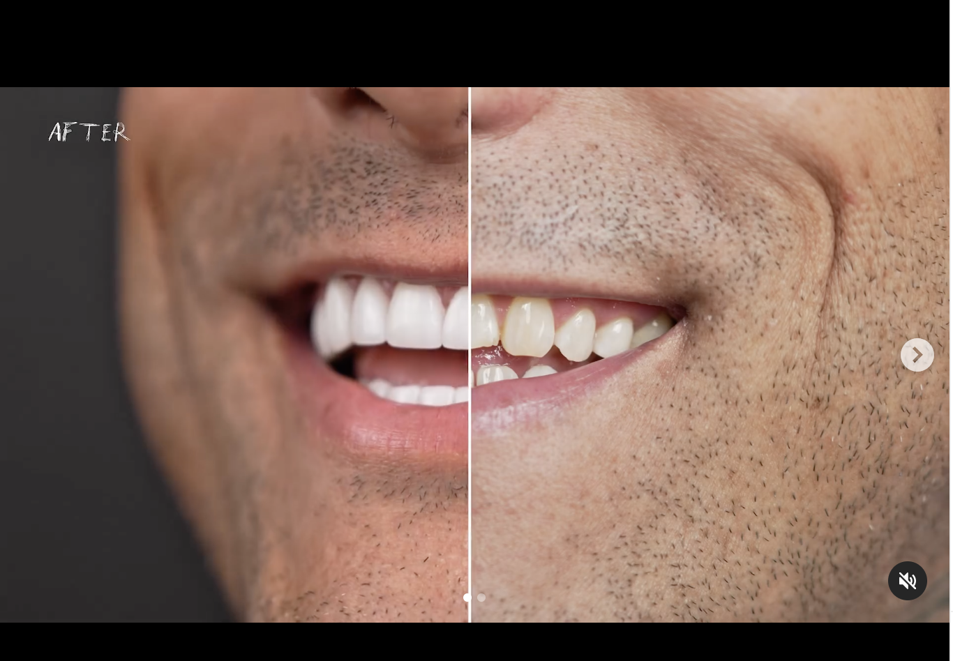 Who Should Get Veneers