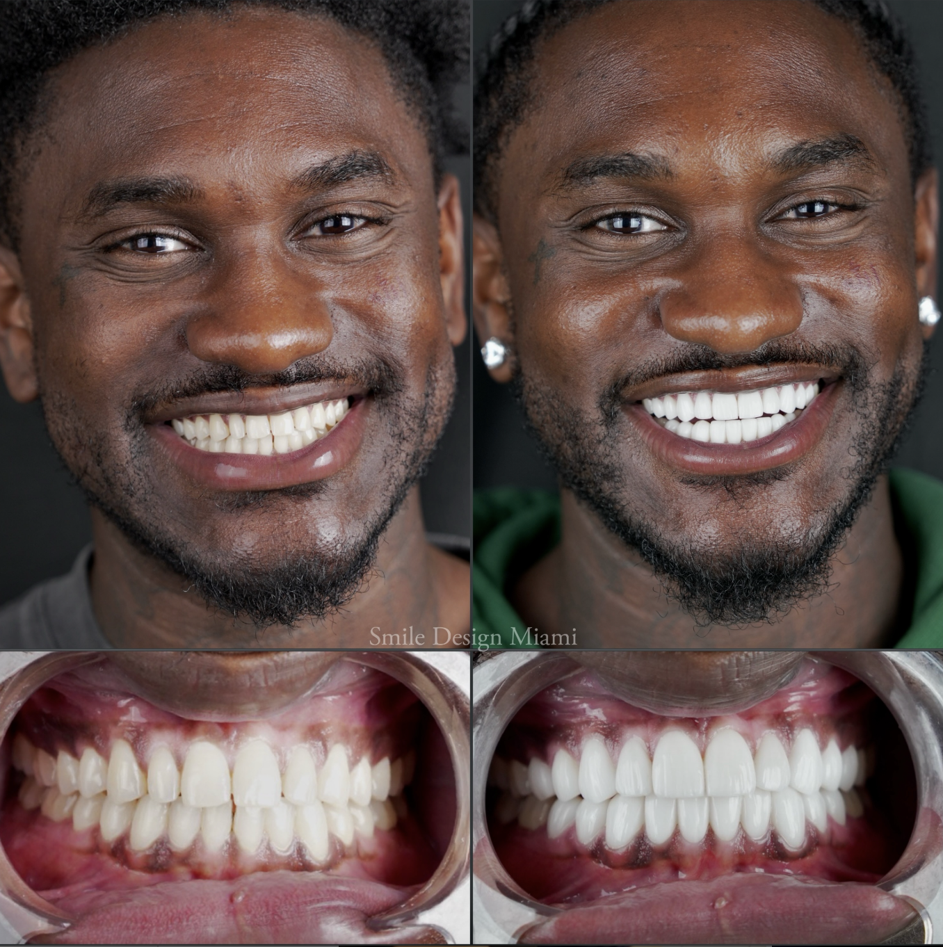 Dental Cleaning Frequency